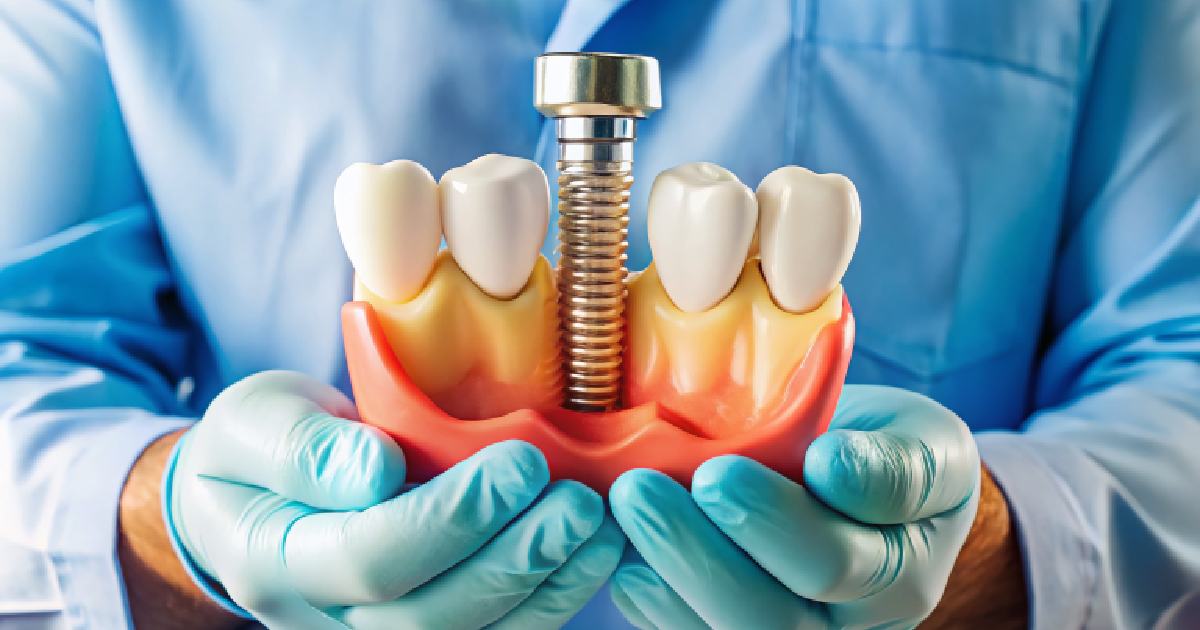 De ce ar putea fi necesară grefa osoasă înainte de implanturile dentare